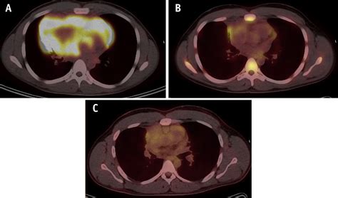 Primary Mediastinal B Cell Lymphoma The Role Of Consolidative