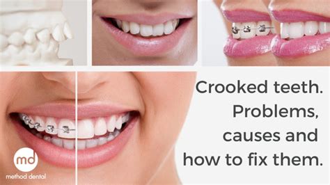 How To Make My Teeth Crooked Teeth Poster