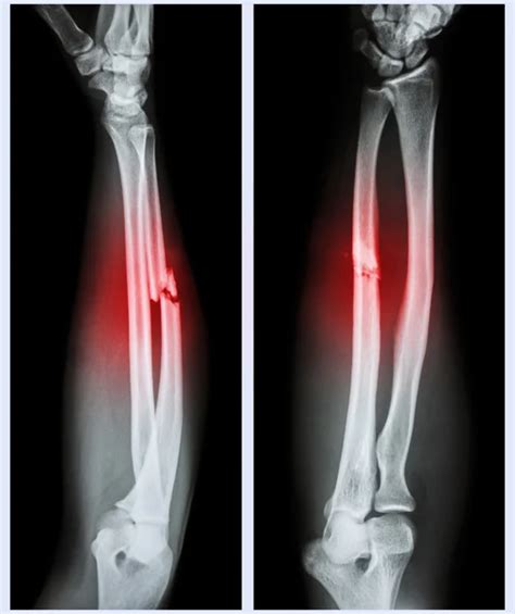 Fracture Both Bone Of Forearm It Was Operated And Internal Fixed With