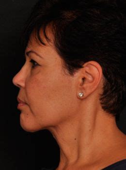 Pin On Before And After Neck Lift Surgery