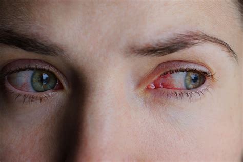 Pink Eye Vs Allergies Causes Symptoms And Treatment Stuffy Nose