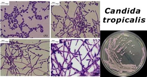 Candida Tropicalis An Overview