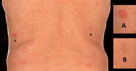 A Differential Diagnosis For Annular Lesions Contact Dermatitis To