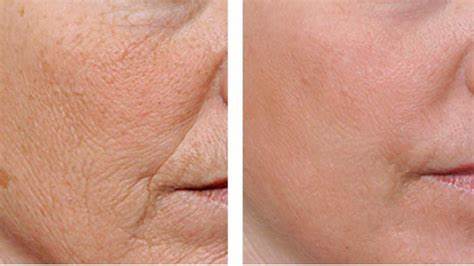 Похудела и кожа стала дряблой