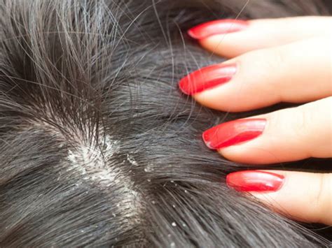 Can Yeast Infections Form On The Scalp Blackdoctor