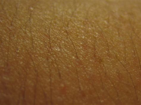 How To Get Rid Of Chicken Skin Keratosis Pilaris Explained