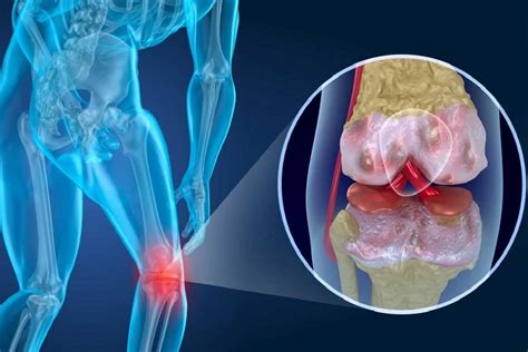 Artritis Definición Diagnóstico Tratamiento Y Pronóstico