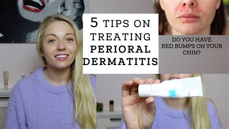 Tips On How I Treated My Perioral Dermatitis Youtube