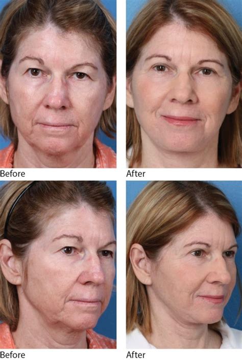 Are Laser Assisted Facelifts The Newest Trend Aesthetic Insider