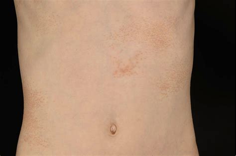 Pityriasis Rubra Pilaris With Histologic Features Of Lichen Nitidus