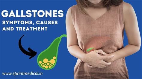 Gallstones Cholelithiasis Symptoms Causes And Treatment Sprint Medical