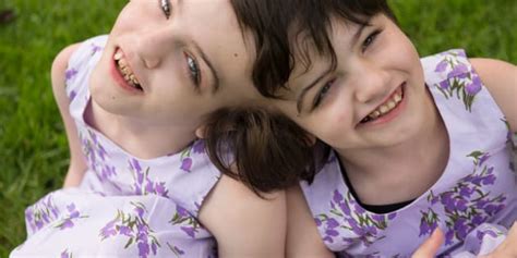 Ten Years In The Life Of Conjoined Twins