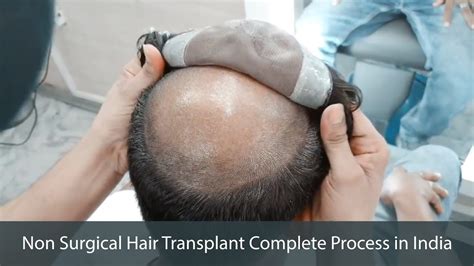 Before And After Non Surgical Hair Transplant Complete Process In India 2019 Youtube