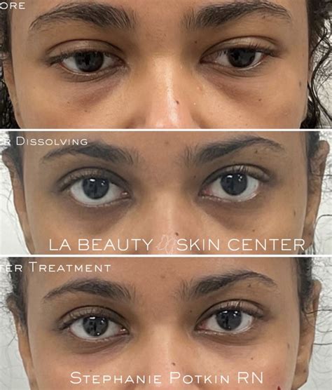 Under Eye Treatment La Beauty Skin Center Usa
