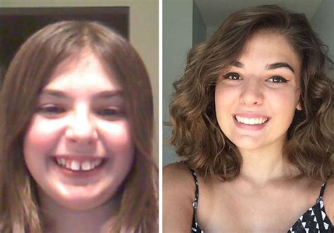 114 Incredible Before And After Transformations Of People Who Wore Braces