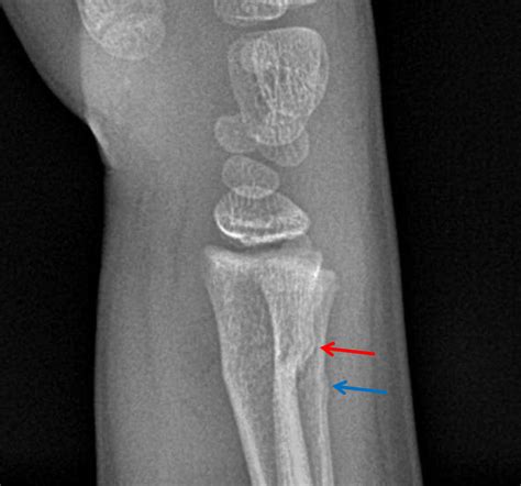 Buckle Fracture Of Distal Radius