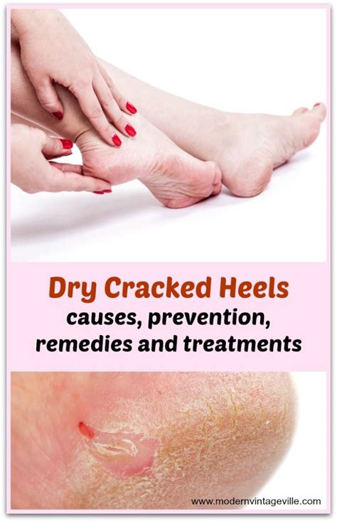 Dry Cracked Heels Causes Prevention Remedies And Treatments Artofit