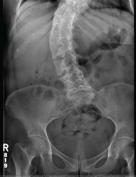 Kub And Pelvic Xr Of This Patient Shows Characteristic Severe Scoliosis