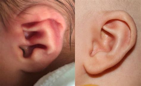 Ask The Expert What Are The Most Common Pediatric Ear Deformities