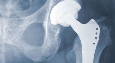 Metal On Metal Hip Implant Failure Pennsylvania Lawyers