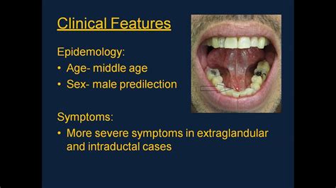 Surg2017 Lvc 001 Sialolithiasis Youtube