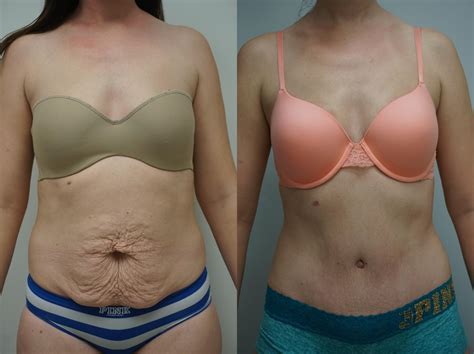 Tummy Tuck Abdominoplasty Plastic Surgery Free Hot Nude Porn Pic