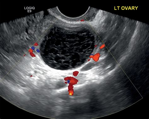 Chapter 8 Sonographic Assessment Of Ovarian Cysts And Masses Obgyn Key