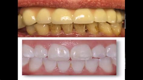 How To Stain Your Teeth Yellow For Halloween Anns Blog