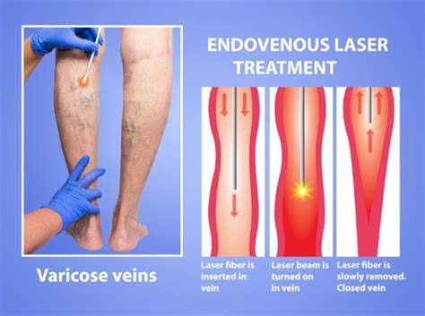 Varicose Veins Treatment In Phoenix Az Laser Vascular Center