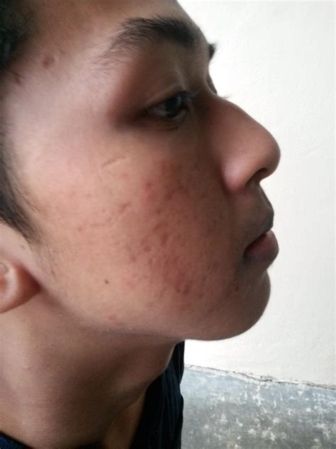 Acne Marks After Retin A Help With Photos Hyperpigmentation Red