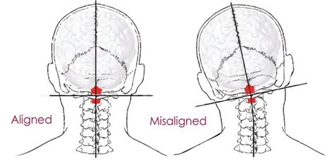 Atlas Misalignment Null Chiropractic