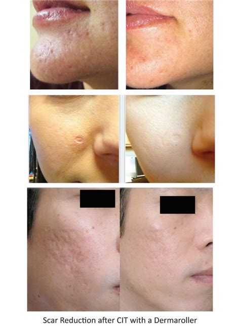 Acne Scars Before And After Derma Roller