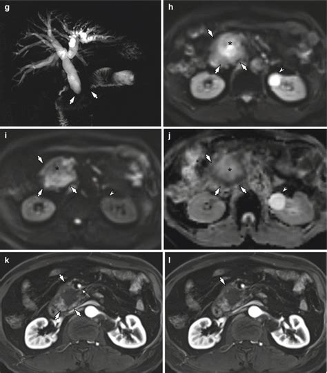 Imaging Diagnosis Of Pancreatic Cancer Ct And Mri Springerlink