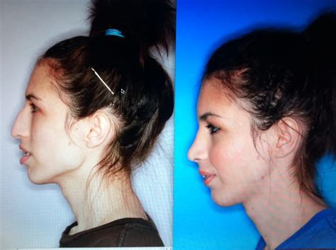Before And After Pictures Of Jaw Surgery Oral Surgery Boca Delray
