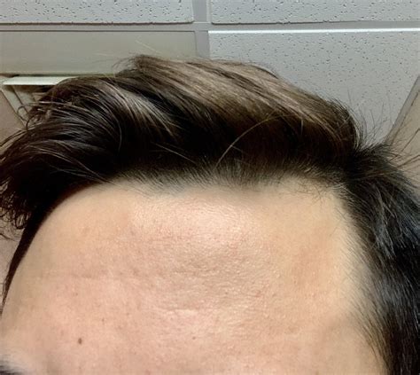 Skin Concern Highly Textured Forehead And Some Creasesfine Lines On