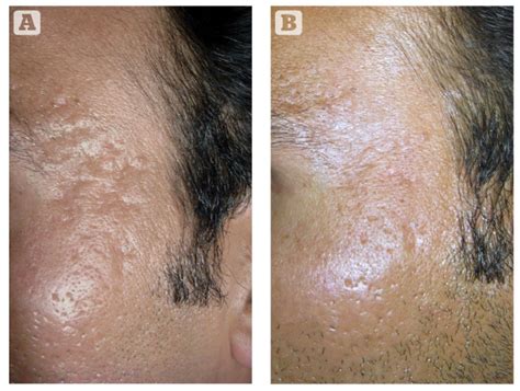 Microneedling And Its Applications In Dermatology Prime Journal