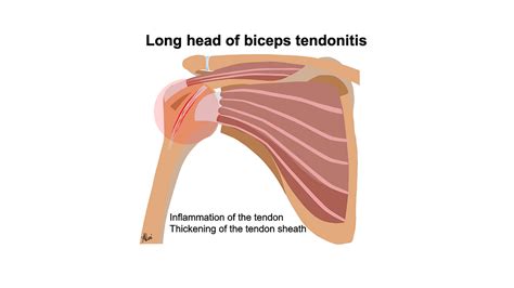 Long Head Of Biceps Tendon Sheath Cortisone Injection Musculoskeletal