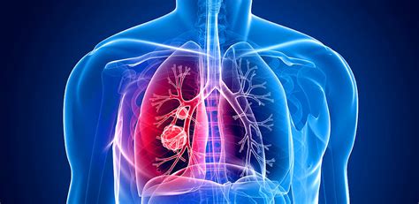 Lungenkrebs Symptome Ursachen Verbreitung