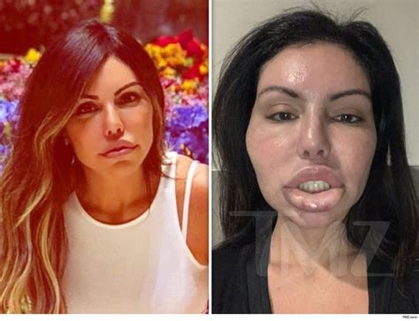 Liziane Gutierrez Suffers Face Swell After Another Botched Plastic Surgery