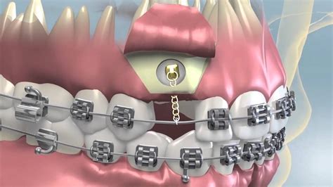 Impacted Tooth Exposure And Uncovering For Orthodontics Youtube