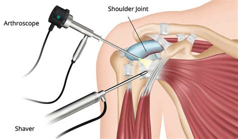 Shoulder Arthroscopy Procedure Anatomy Recovery Time Rehab Protocol
