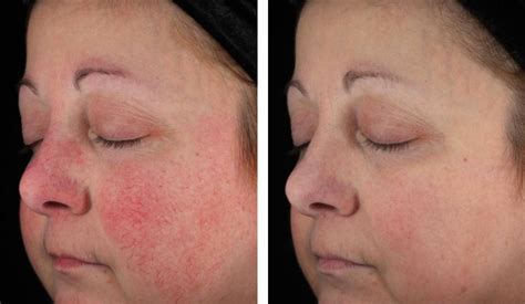 Maintaining Healthy Skin At Home From Mild Acne To Rosacea Dr