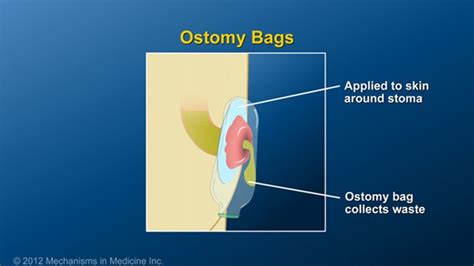 Any Waste That Drains Out Of The Stoma Is Collected By An Ostomy Bag