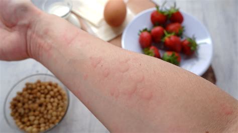 5 Meals Allergy Triggers Of Hives And Pores And Skin Rashes Cuana