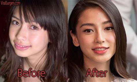 Now, cosmetic and reconstructive procedures are quite common, and many do not even require invasive measures. Angelababy Plastic Surgery, Before and After Jaw Surgery ...