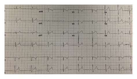 Ekg Showing Sinus Rhythm With Rate Of 56 Bpm And Pr Interval Of 180 Ms