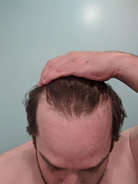 Just Turned 27 Recently And Have Noticed Some Hair Falling Out I Dont