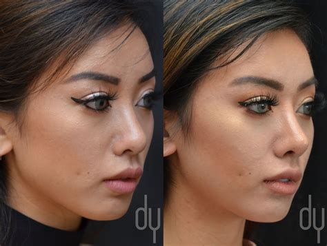 Nose Job Before And After Asian Jordon Corona