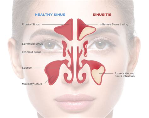 Understanding Sinusitis Chart Ph