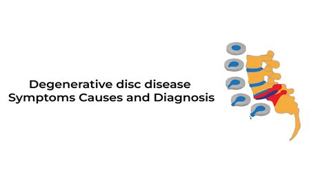 Degenerative Disc Disease~ Stat Cardiologist